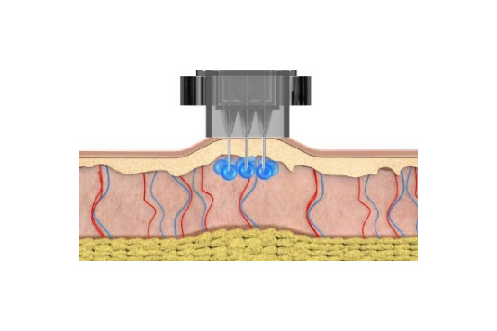 水光注射（Bellapro）イメージ写真