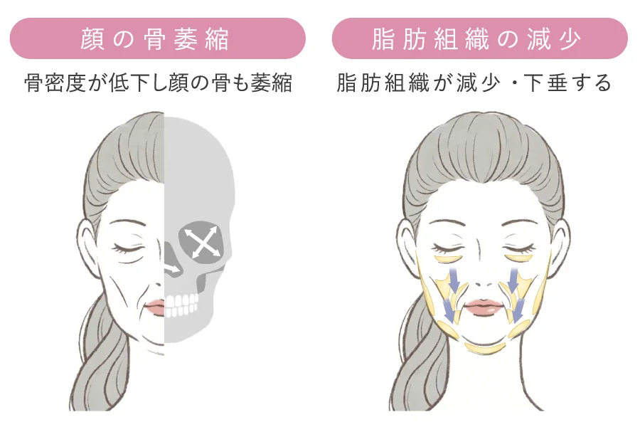 顔の骨萎縮と脂肪組織の減少