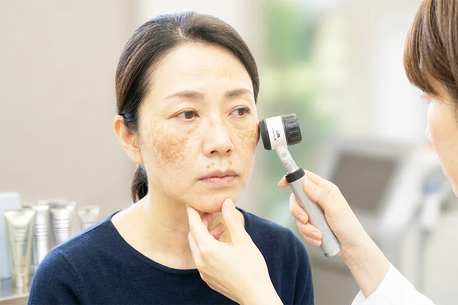 肝斑など誤った治療で悪化するシミの注意