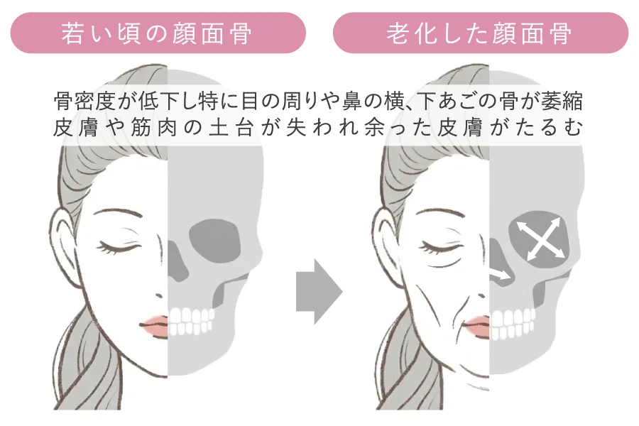顔面骨の萎縮・減少
