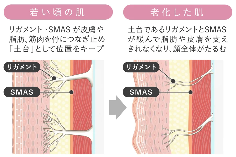 支持靭帯・SMAS筋膜のゆるみ