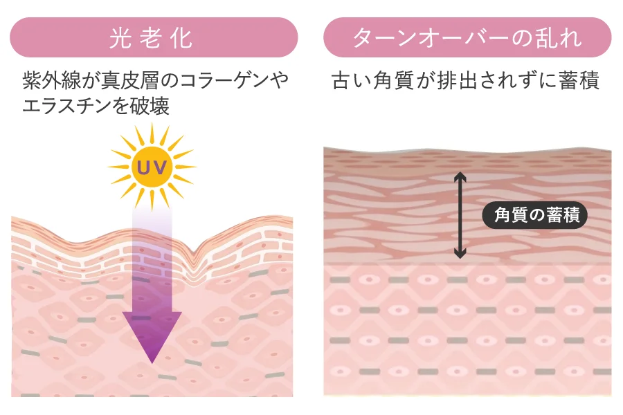 光老化と角質肥厚による肌の衰え