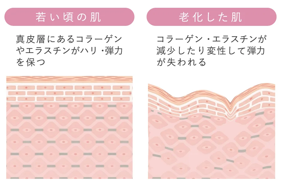 真皮層のコラーゲン・エラスチン減少による弾力低下