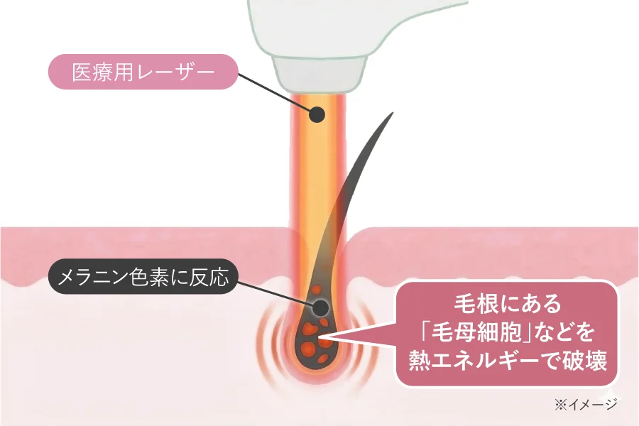 医療脱毛のメカニズム