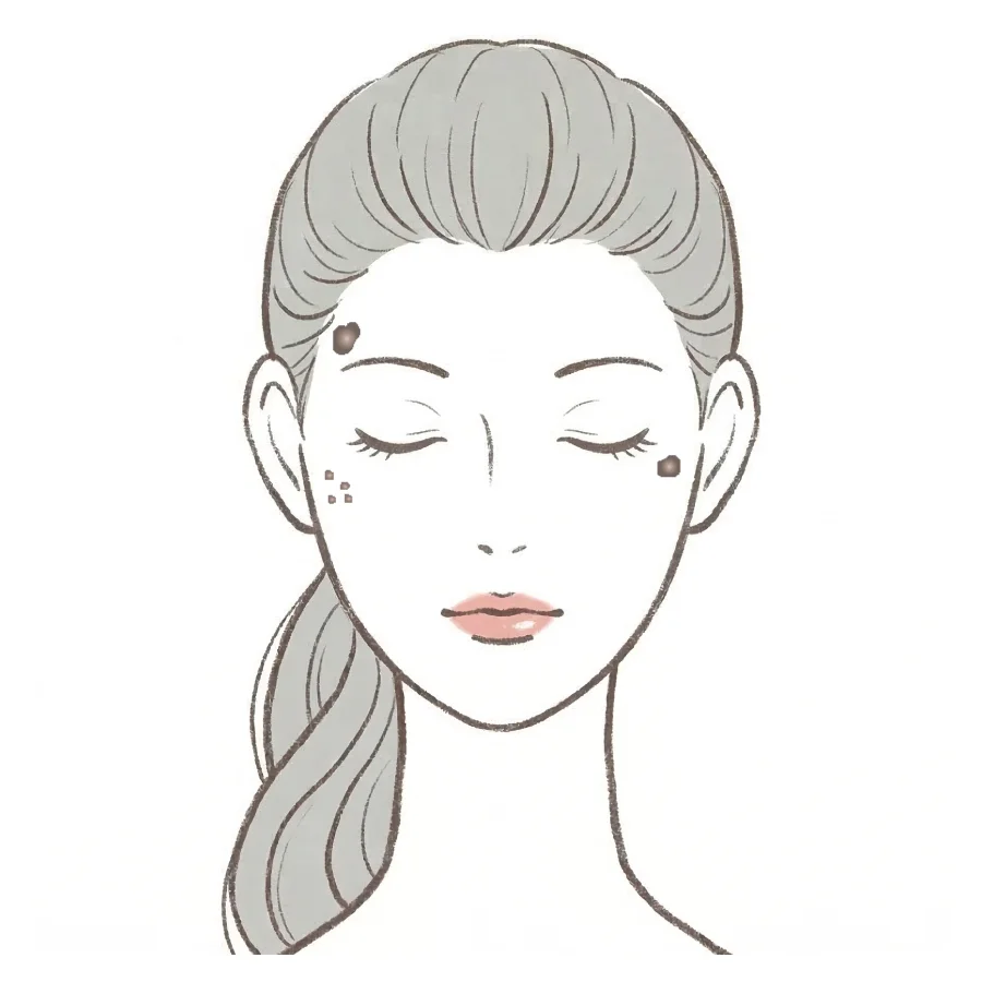 脂漏性角化症(老人性イボ)のイメージ