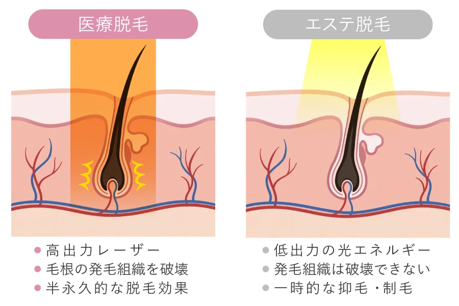 医療脱毛とエステ脱毛の比較