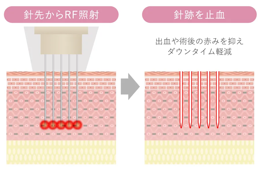 針と同時に高周波を照射して止血する仕組みの図解