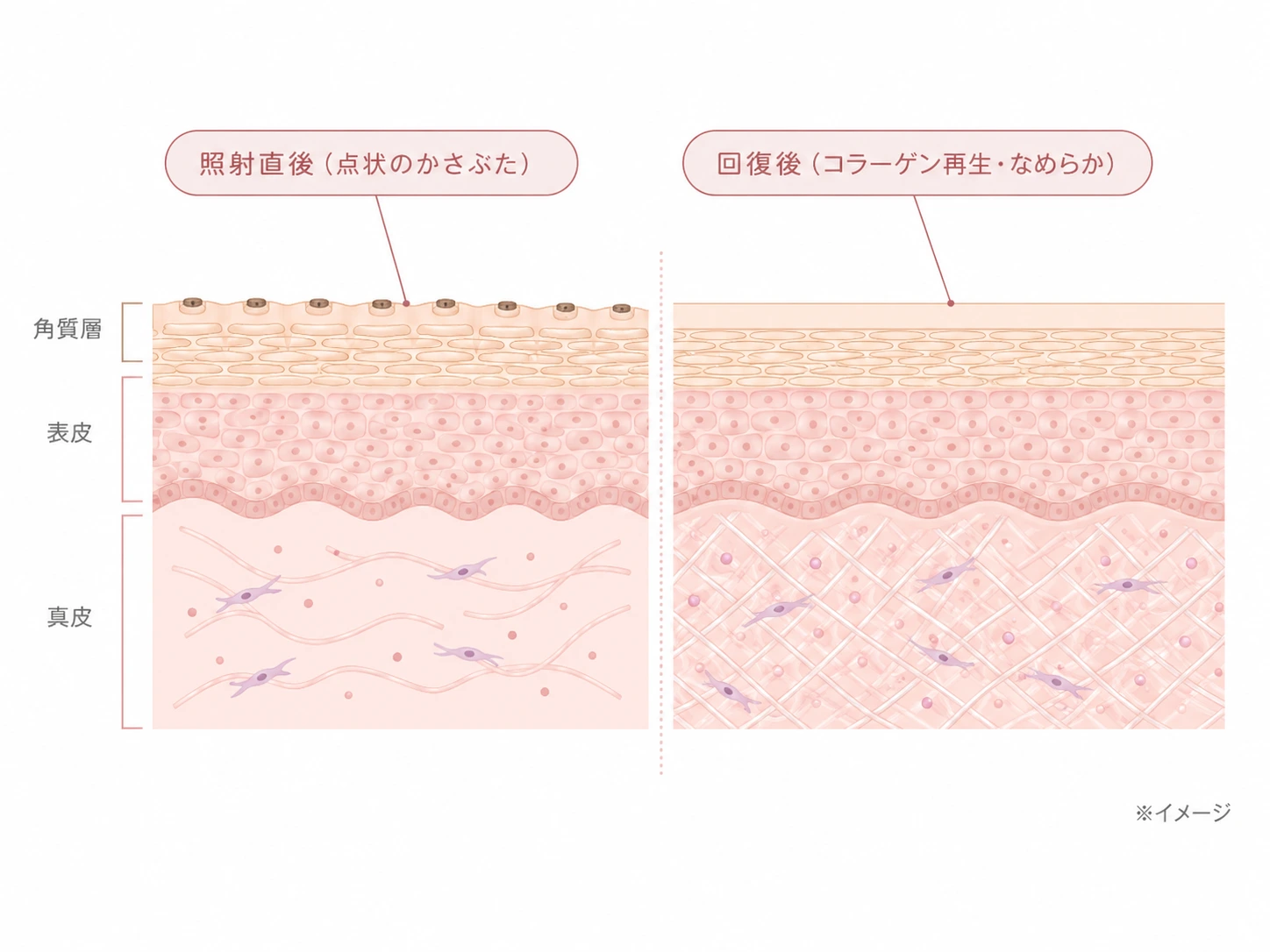(仮)差し替え予定: 照射直後の点状のかさぶたと、回復後にコラーゲンが再生しなめらかになった肌をラベル付きで示した断面解説図