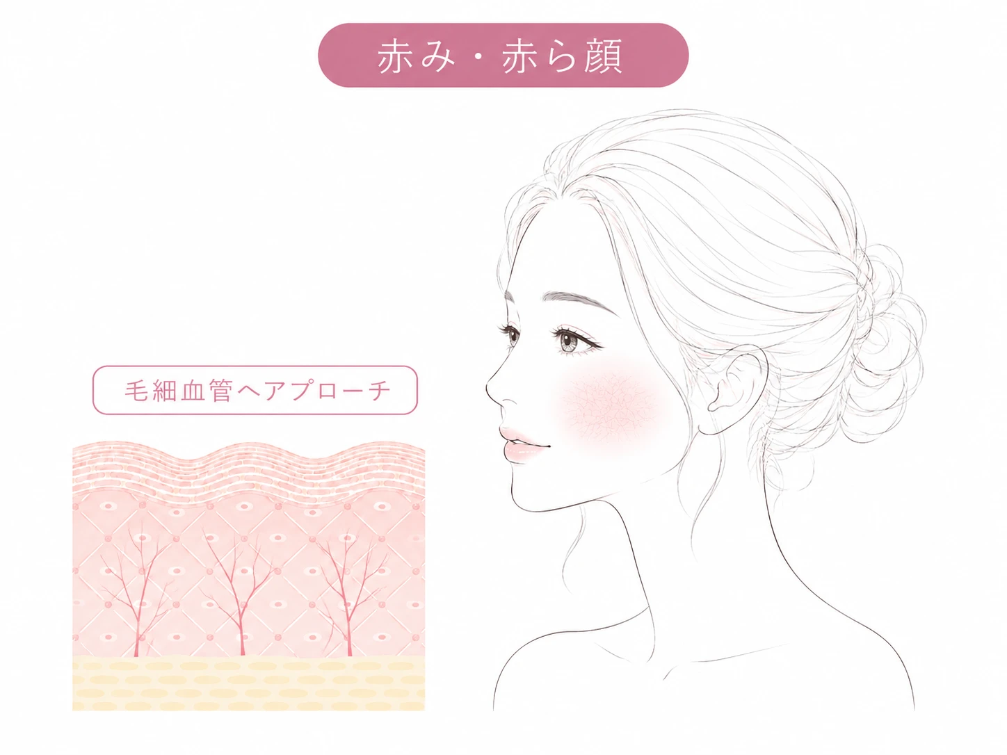 赤み・毛細血管のお悩みイメージイラスト