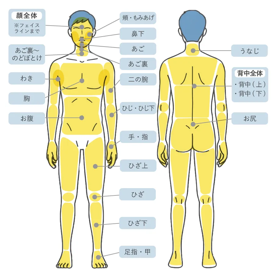 男性脱毛 部位図