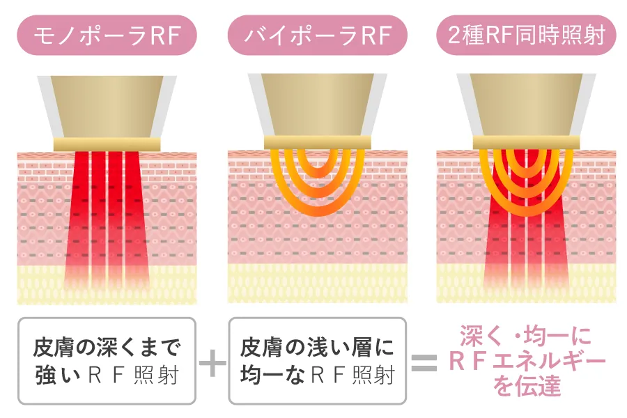 モノポーラとバイポーラの2種のRFを連続照射するダイヤモンドチップの図解