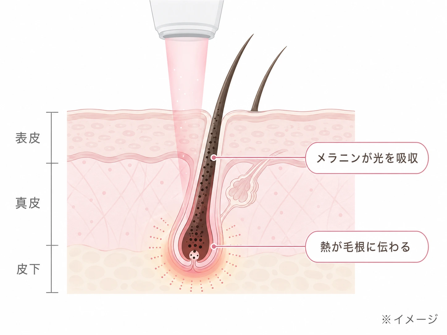 (仮)差し替え予定: メカニズム図 医療レーザー脱毛（メラニンにレーザーが吸収され熱が毛根へ伝わる肌断面）