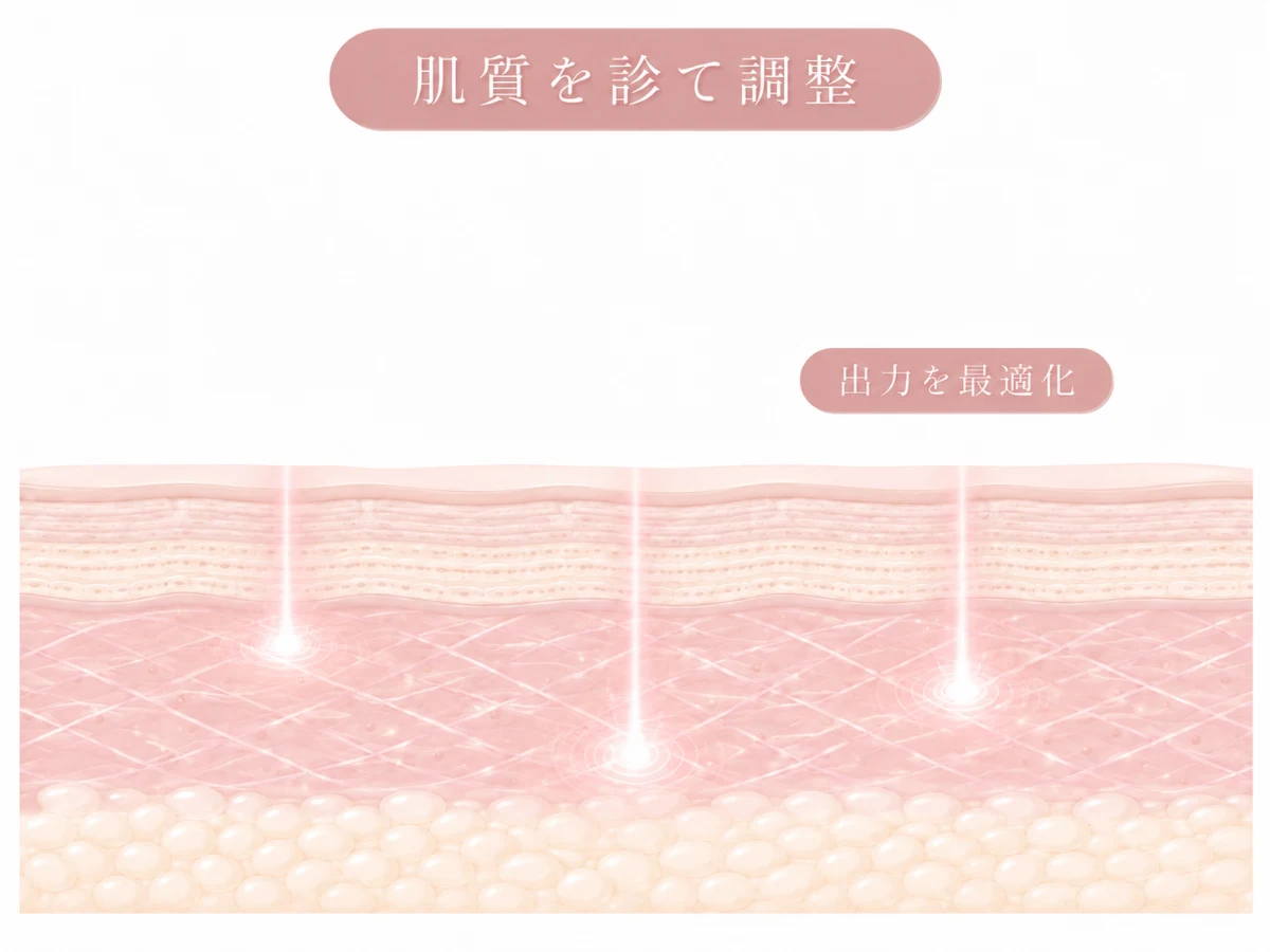 医師が肌質を診て出力を調整する様子を示した肌断面のイメージイラスト