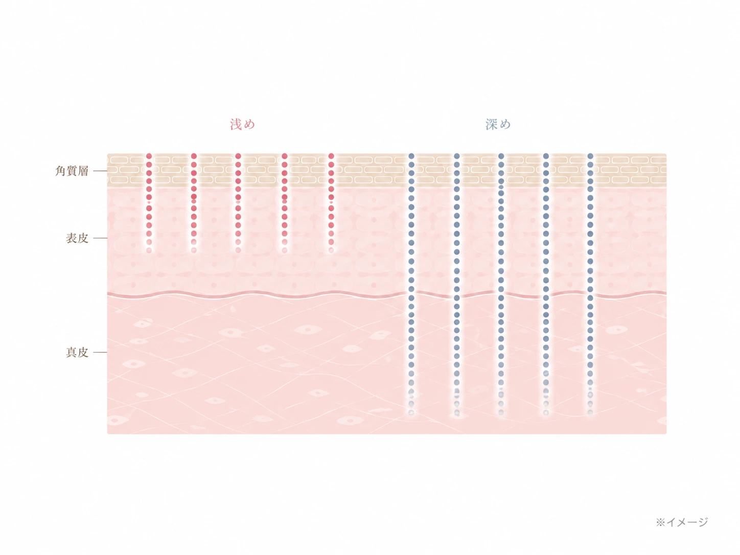 照射の深さを浅・深と調整する様子を示した肌断面のイメージイラスト