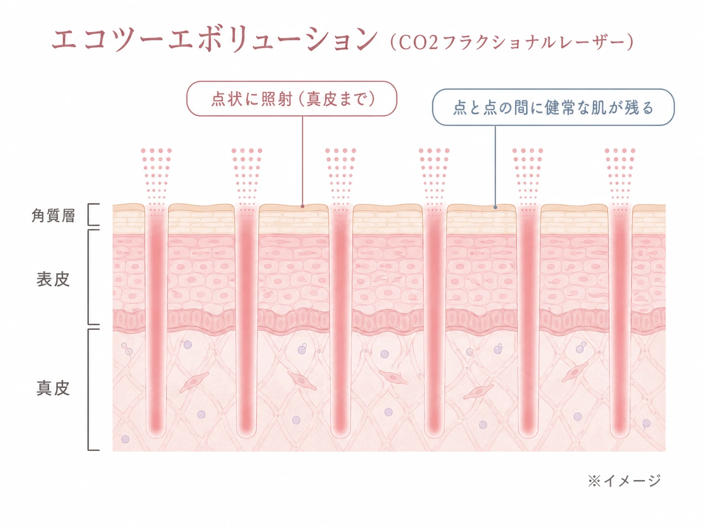 (仮)差し替え予定: CO2レーザーが点状（フラクショナル）に照射され真皮まで届き、点と点の間に健常な肌が残る仕組みの解説図