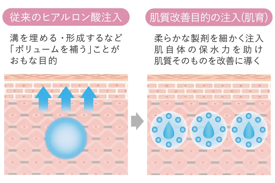 多彩なヒアルロン酸と注入法で肌質改善を叶える図解