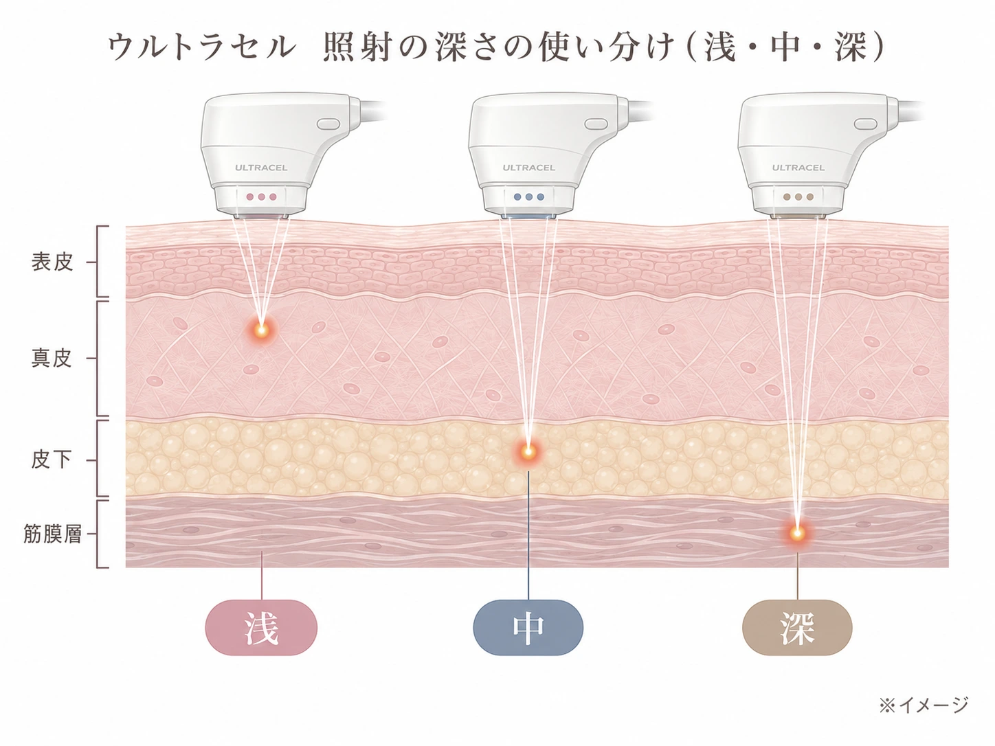 (仮)差し替え予定: 図B 照射深度（カートリッジ）の使い分け。同じ肌断面に浅・中・深の焦点ラインを描き分けたラベル付き解説図