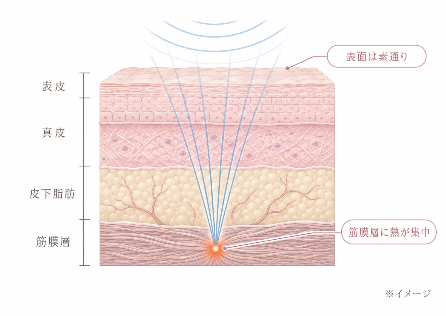 (仮)差し替え予定: 図A HIFUのメカニズム。表皮→真皮→皮下→SMAS筋膜層の断面に深部へ集中する熱凝固点をラベル付きで示した解説図