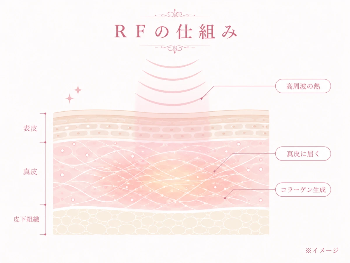 高周波の熱エネルギーが肌の表面をこえて真皮に届き、コラーゲンの生成を促す仕組みを示した解説図
