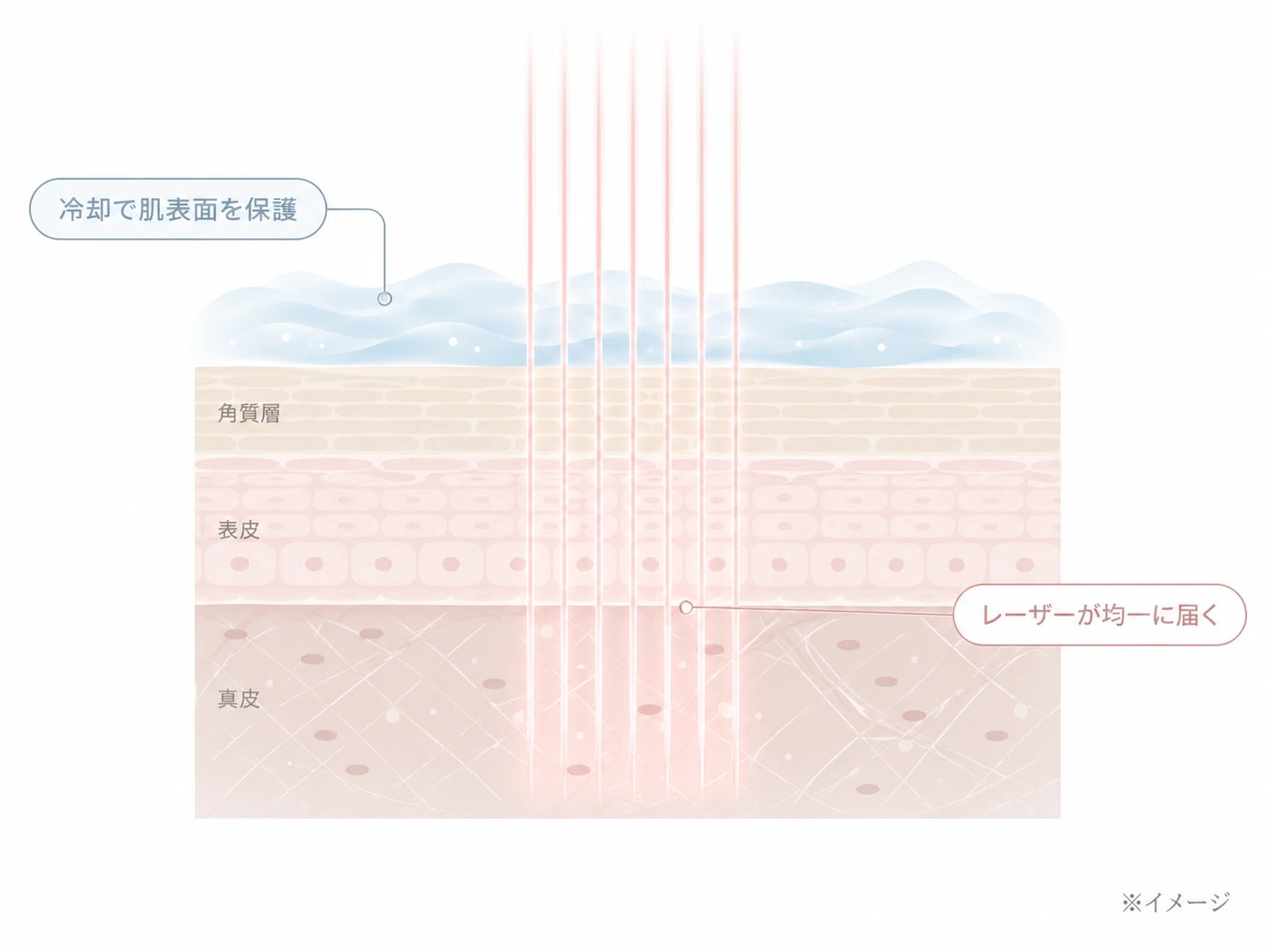 肌表面を冷気が覆いその下にレーザーが届く冷却機構の特徴イラスト