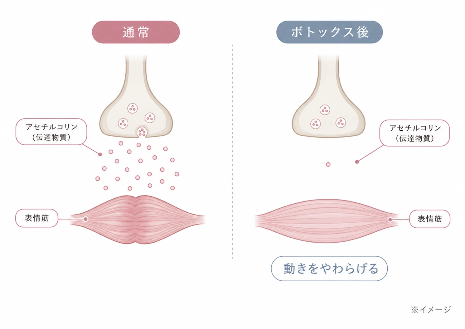 (仮)差し替え予定: メカニズム解説図／神経終末と筋肉の模式図。アセチルコリン放出と、それを抑えてゆるんだ筋肉を対比。ラベル＝神経・アセチルコリン・表情筋・動きをやわらげる