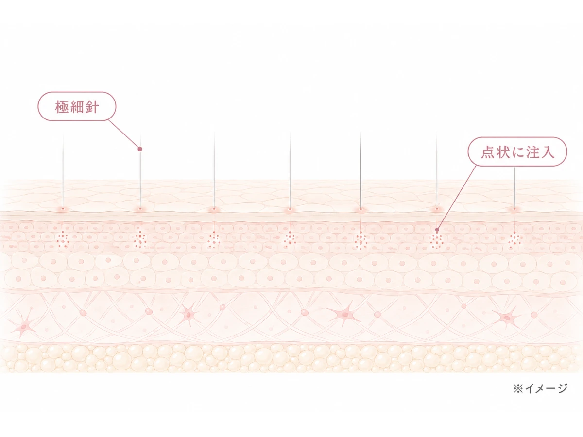 極細針で点状に注入する様子を示した肌断面のイメージイラスト