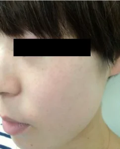 施術後