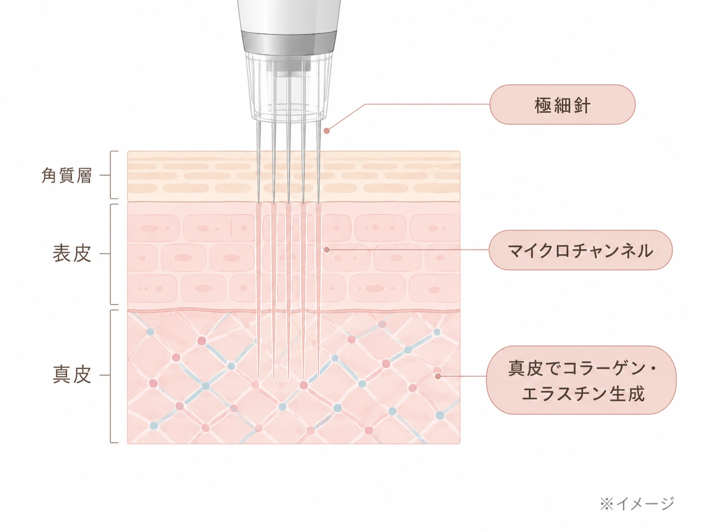 ダーマペン4の極細針が表皮から真皮浅層に刺さりマイクロチャンネルを作り、真皮でコラーゲン・エラスチンを生成する仕組みの解説図