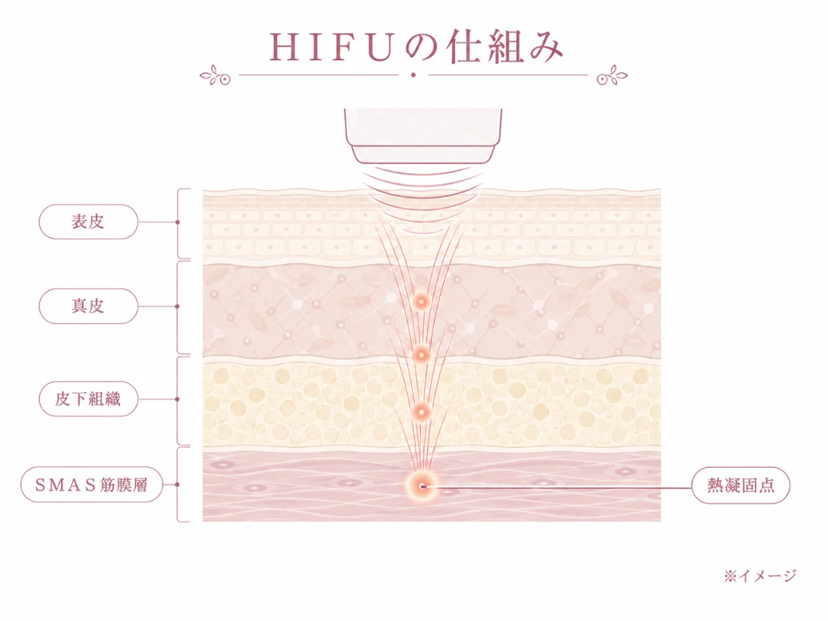 HIFUの超音波がSMAS筋膜層まで届き深部に熱凝固点をつくる仕組みを示した肌断面の解説図