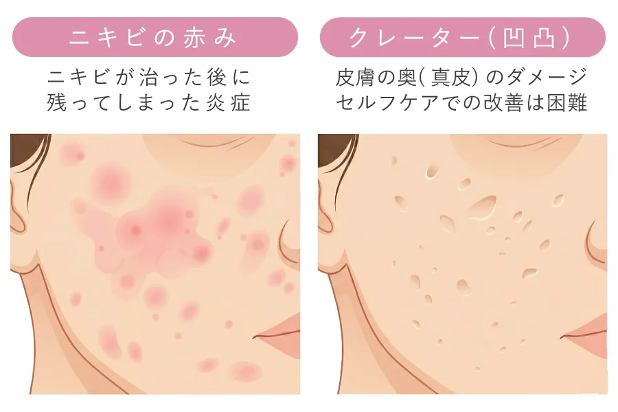 赤みとクレーターのニキビ跡