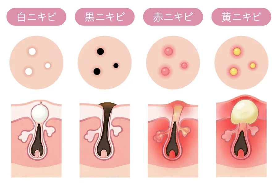 白・黒・赤・黄のニキビの進行4段階