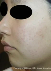 施術後