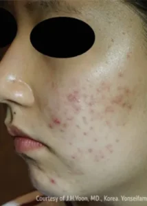 施術前