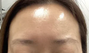 施術後