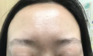 施術前