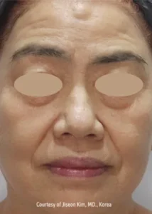 施術後