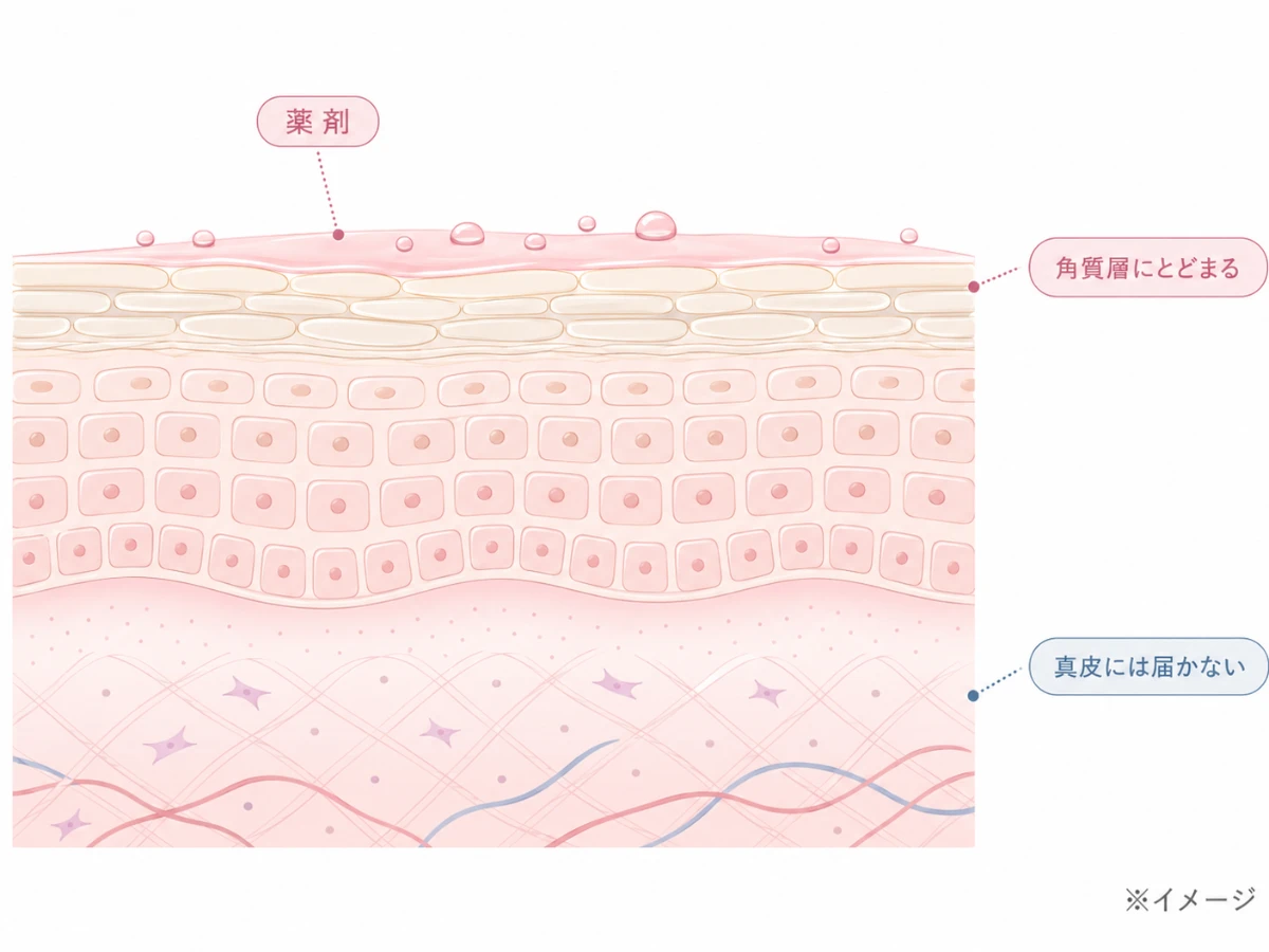 酸が肌の深部まで届かず角質層にとどまる様子を示した肌断面のイメージイラスト