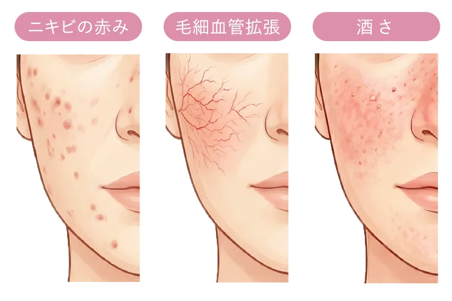 赤ら顔と炎症性疾患による赤みの種類