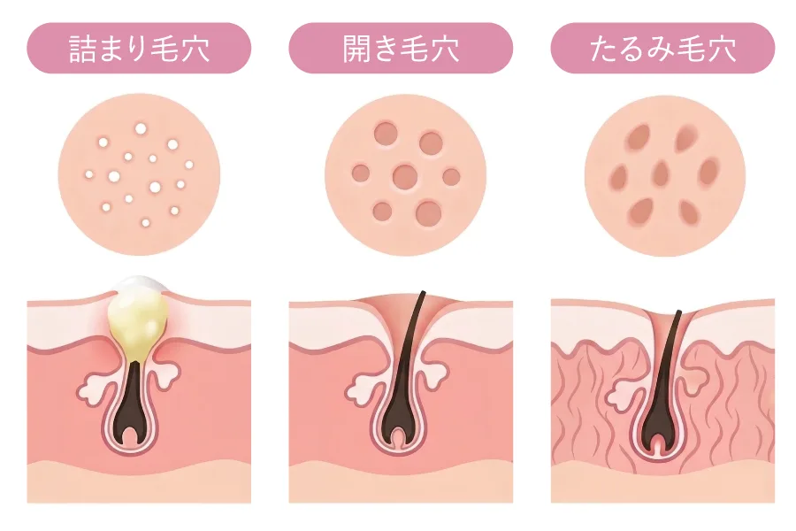皮脂・角質・たるみによる毛穴トラブルの3要因