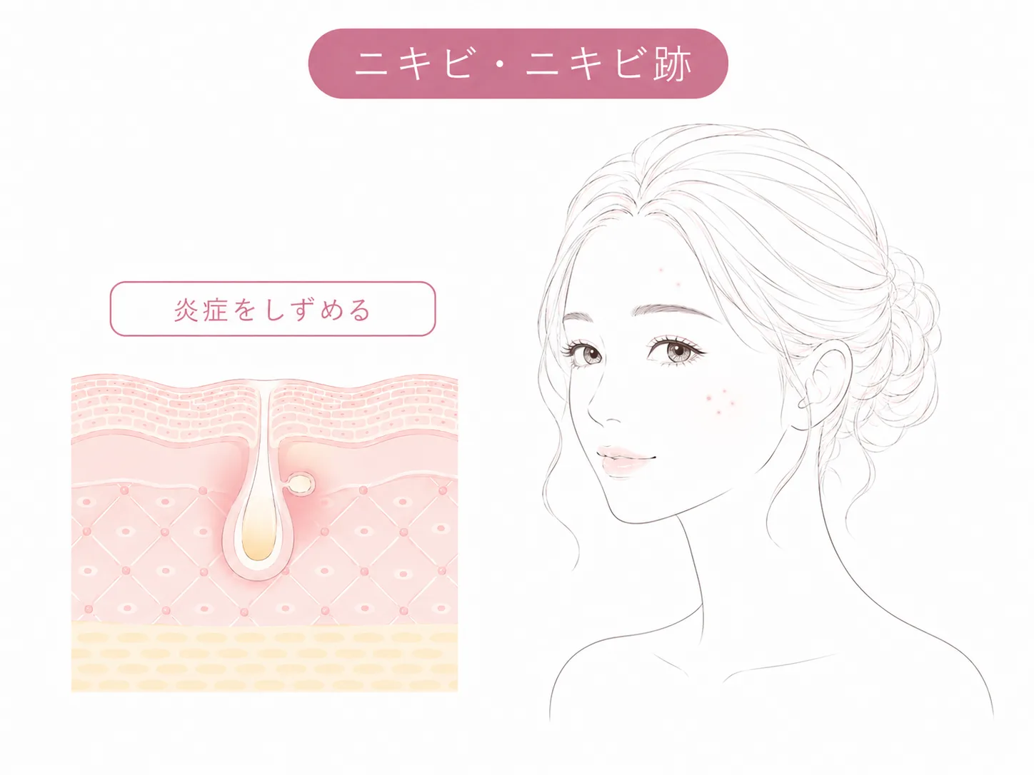 ニキビ・ニキビ跡のお悩みイメージイラスト