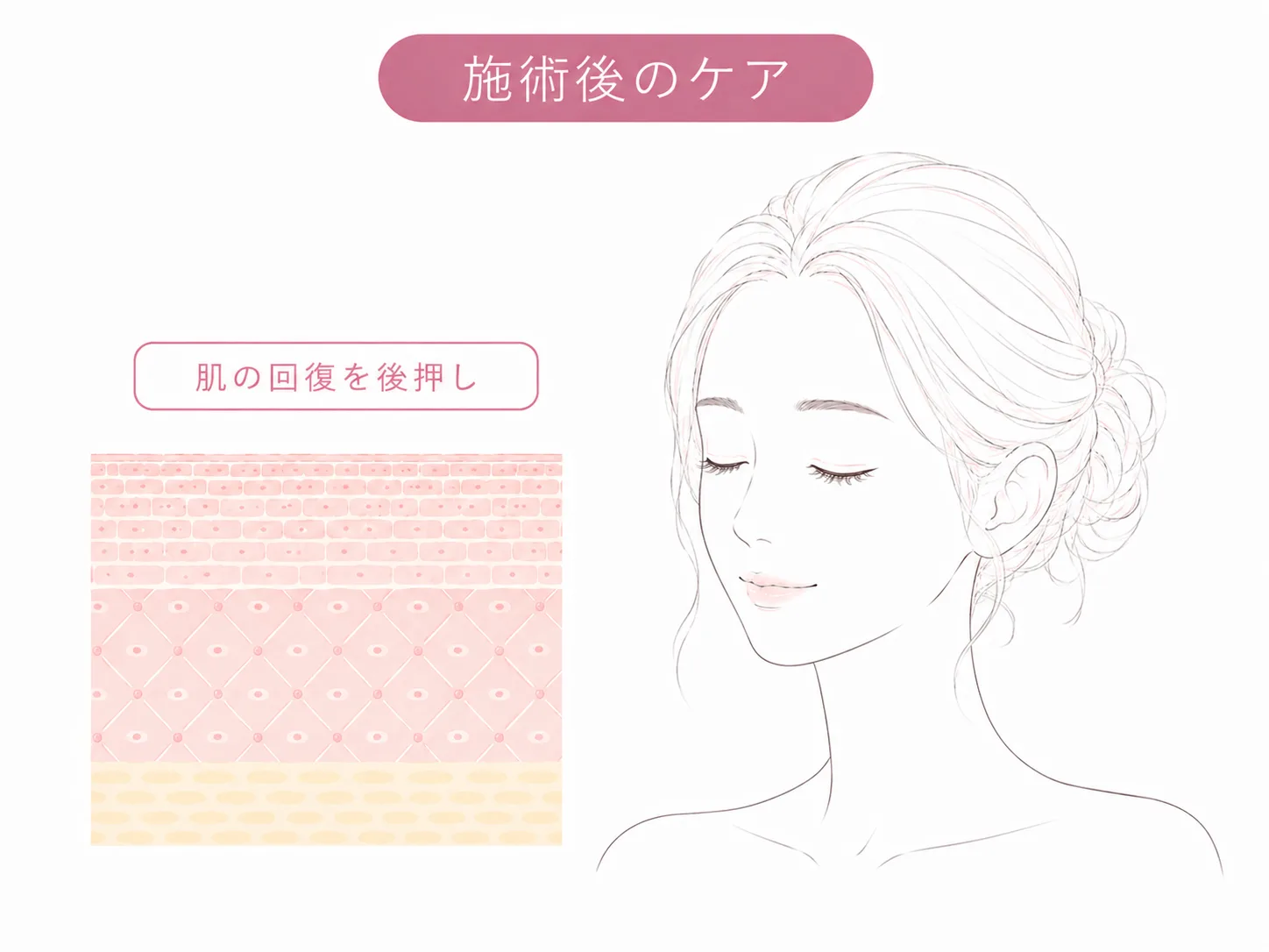 施術後のダウンタイムをいたわるケアのイメージイラスト